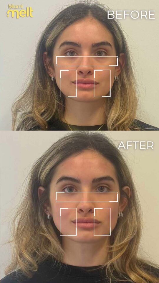 before and after miami facial - radiofrequency and muscle stimulation