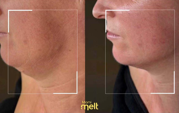before and after wonderface miami melt neck lift sagging skin