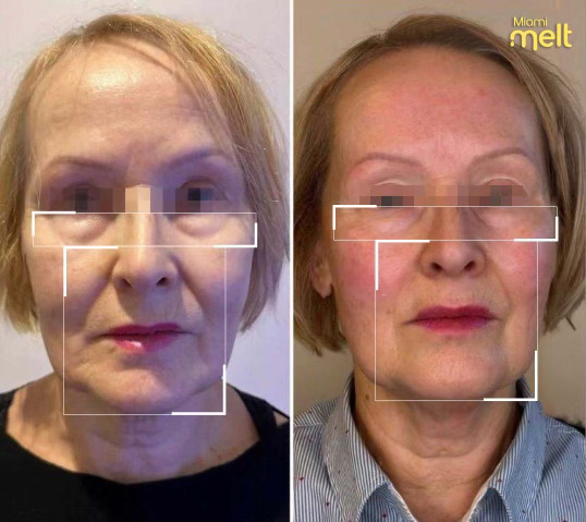 before and after wonderface miami melt face lift skin tightening