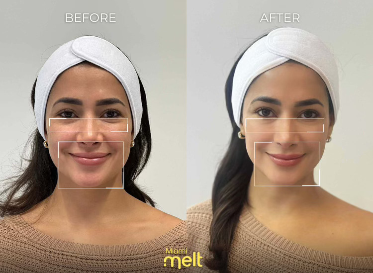 before and after wonderface miami melt face lift