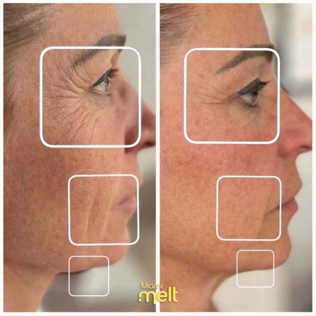 wonderface before and after1