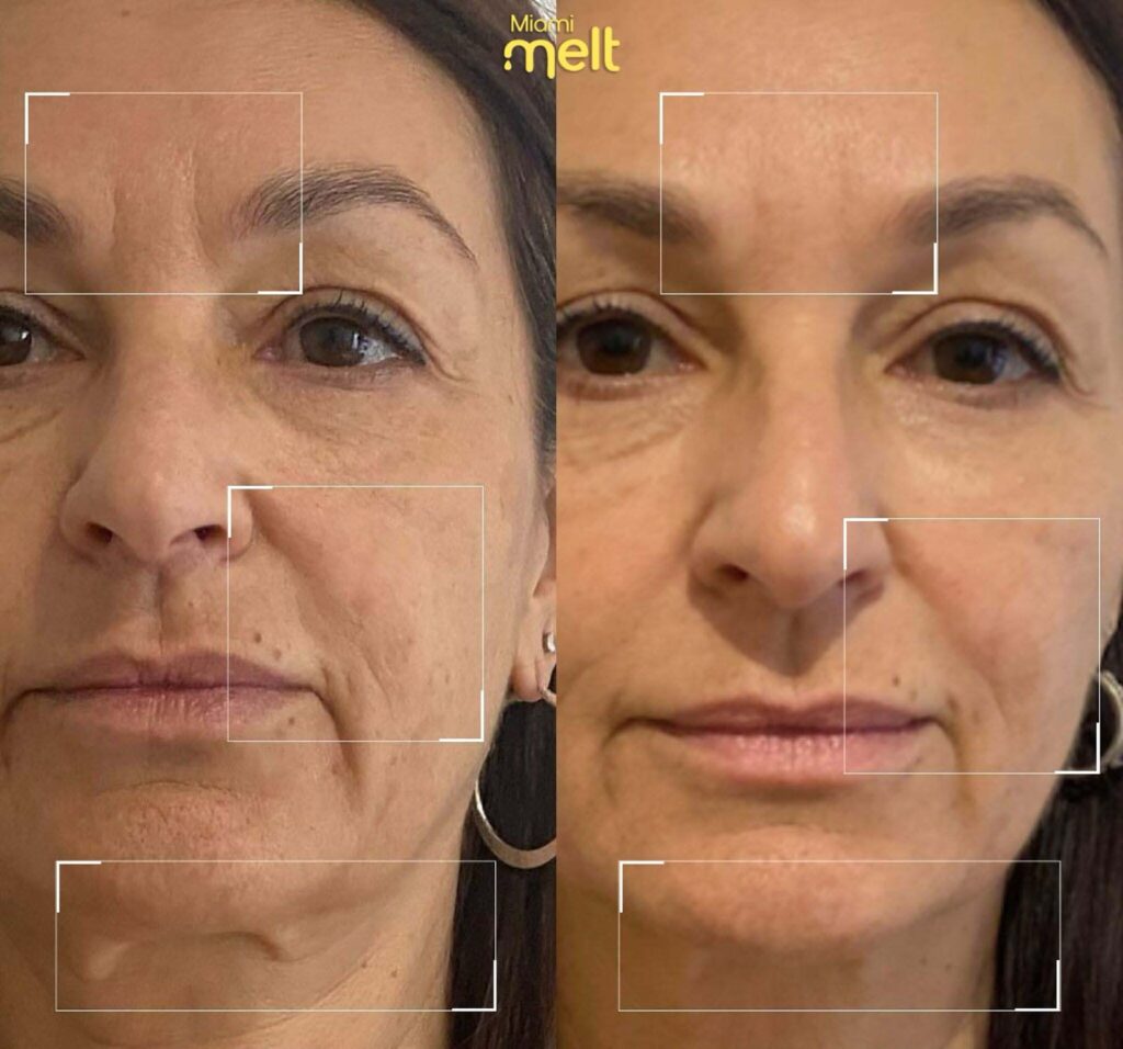 wonderface before and after2