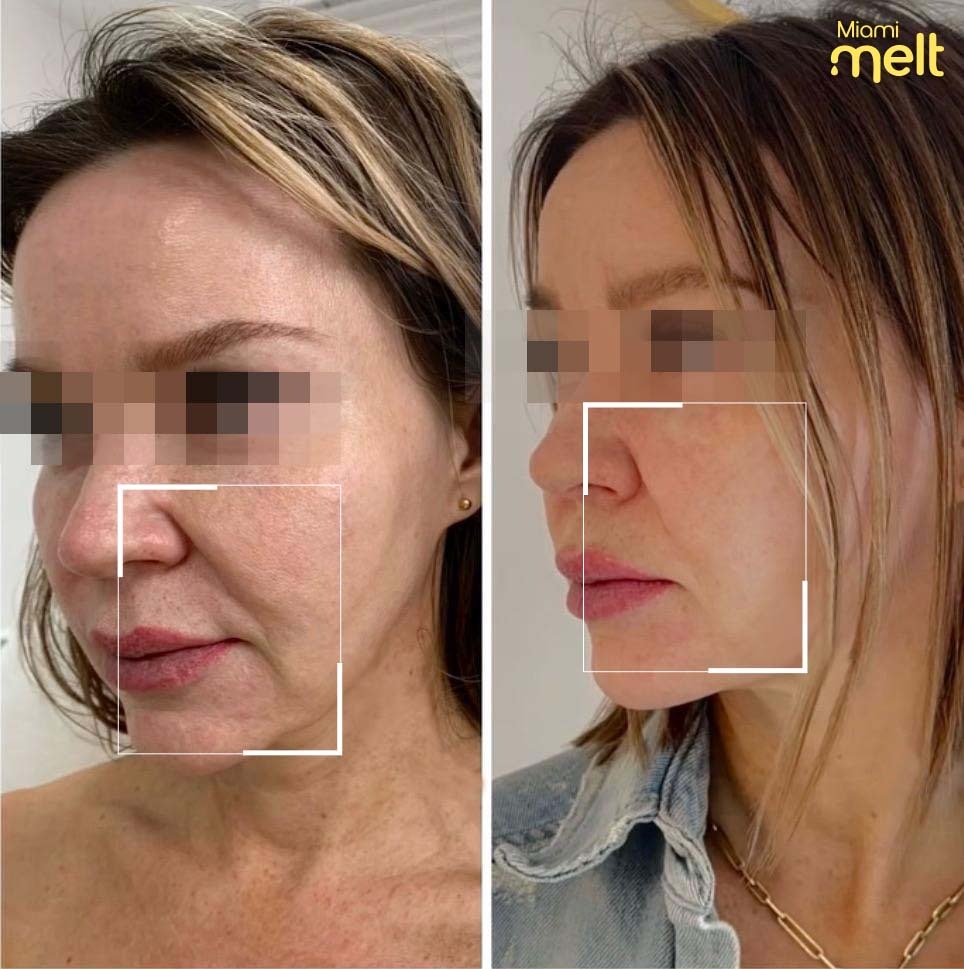 wonderface before and after3