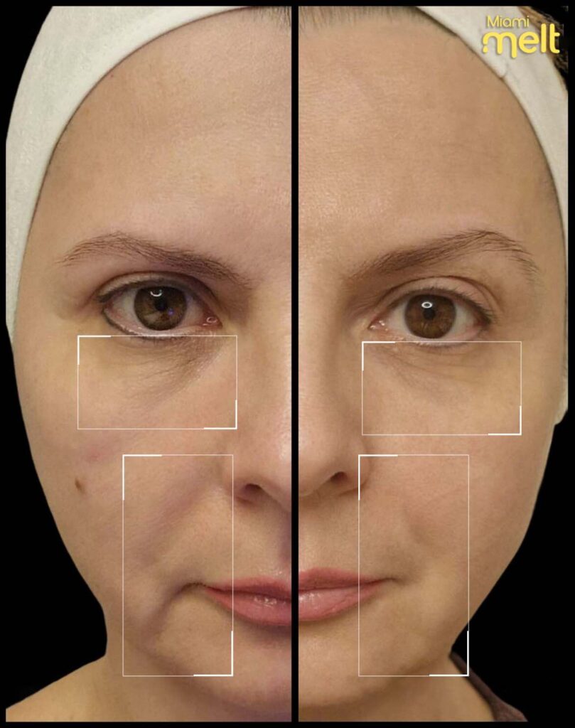 wonderface before and after5
