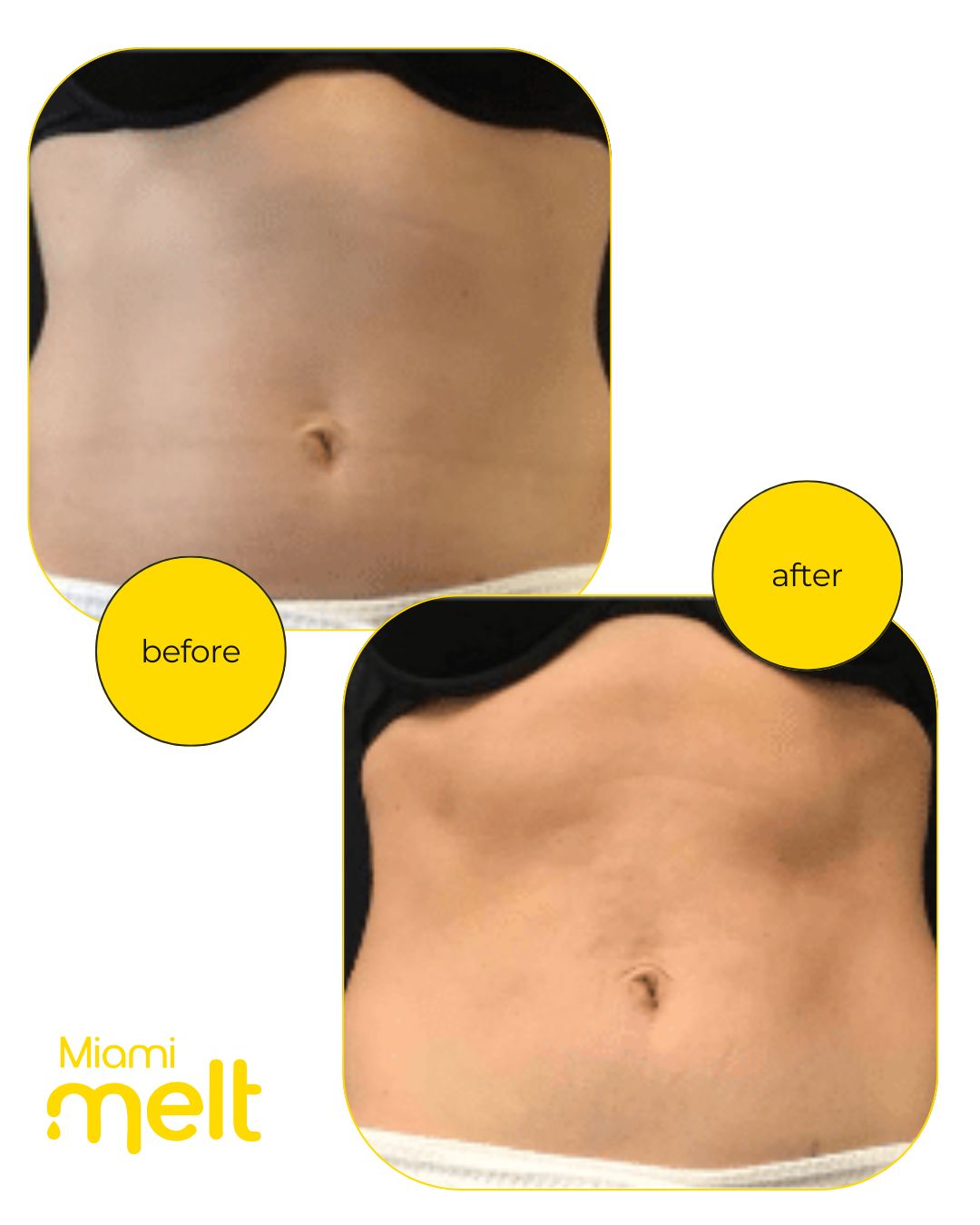 muscle toning near Coral Gables