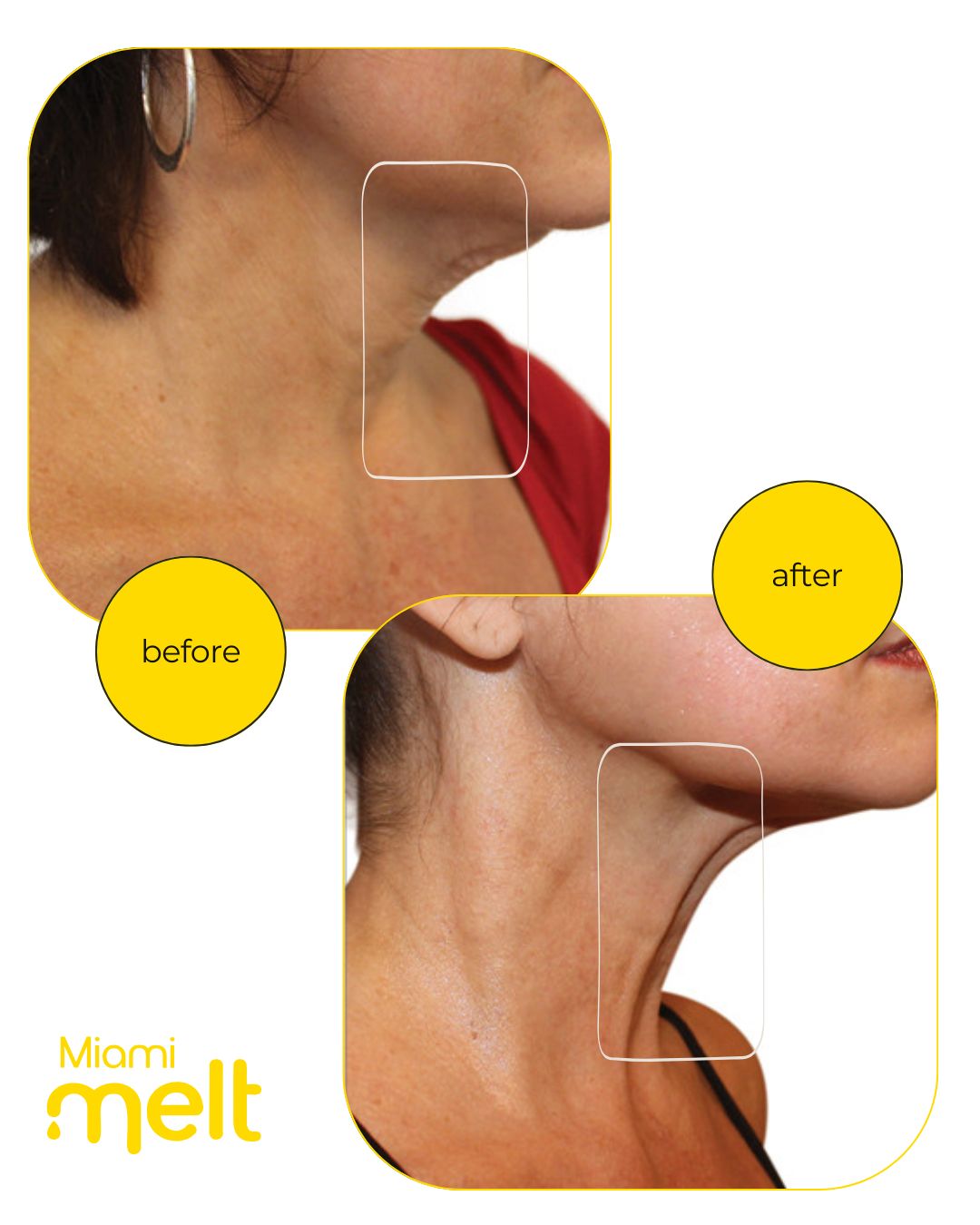 Venus Legacy skin tightening on face