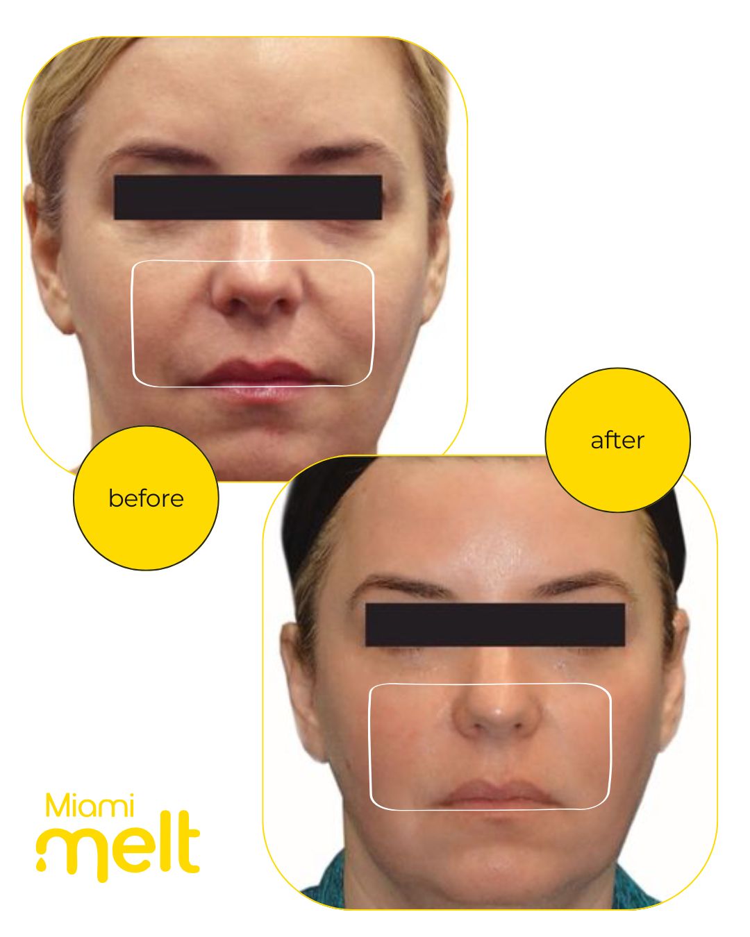Venus Legacy skin tightening on face