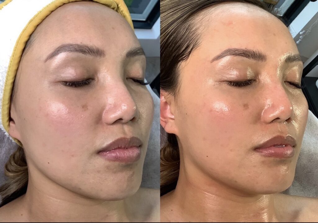aqua facial miami coral gables